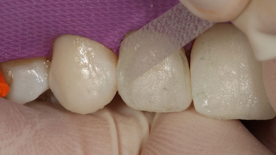 Acabamento e polimento proximal em dentes anteriores: nova técnica