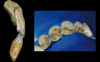 Pinos em dentes anteriores: dificuldade de centralização