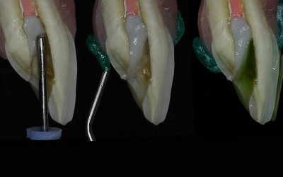 Clareamento interno em dentes tratados endodonticamente